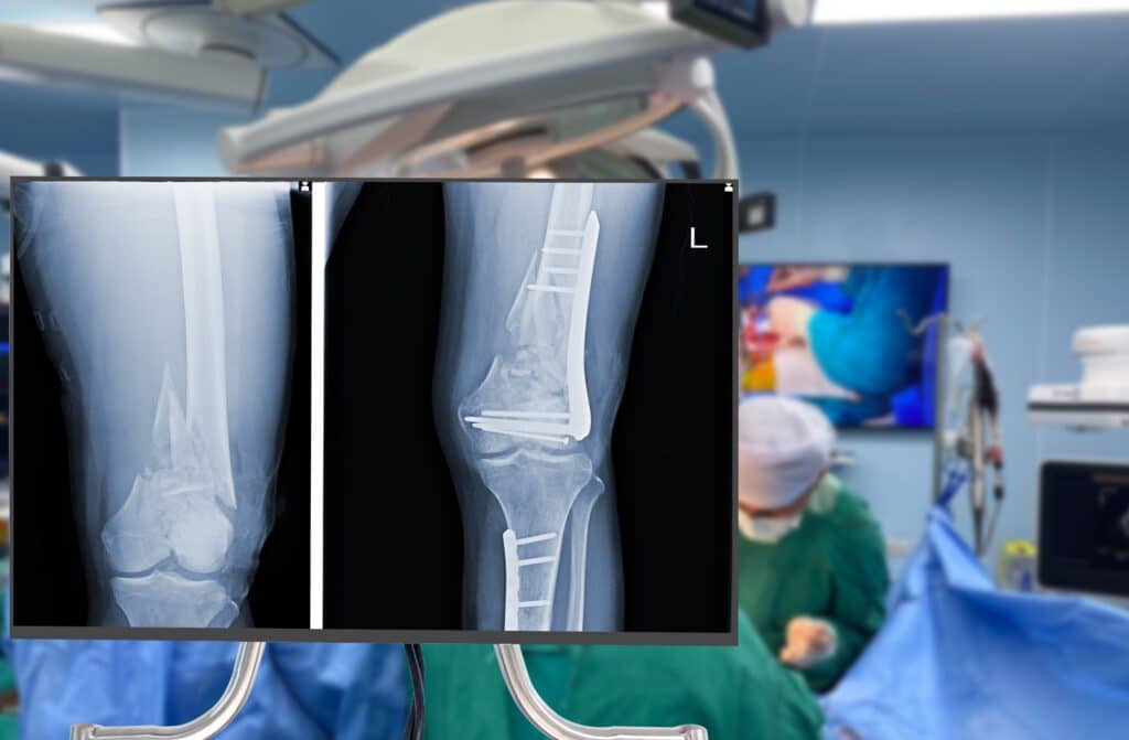 X-ray of leg with surgery in background.