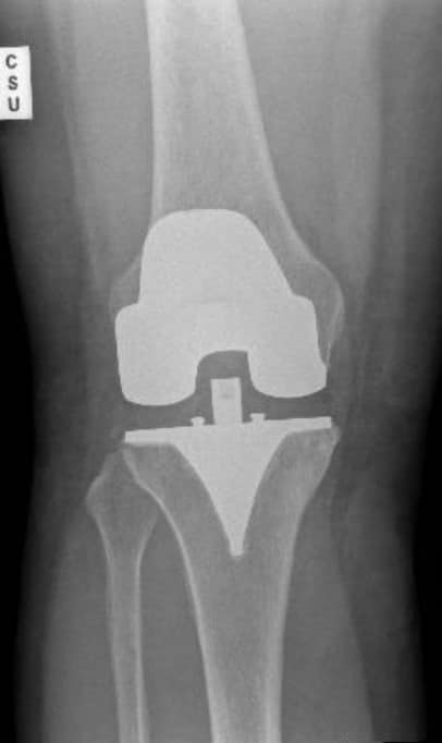 Closeup of knee x-ray.