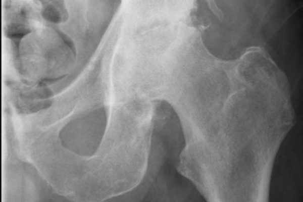 Hip-xray