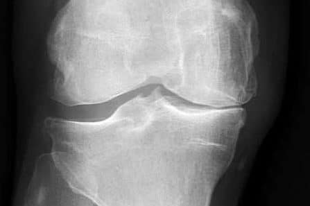 extend physio knee xray