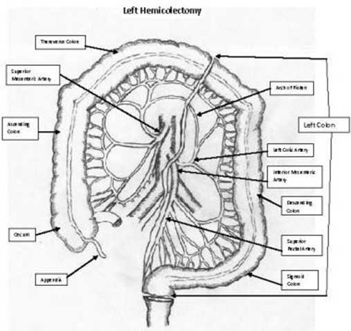Left colectomy